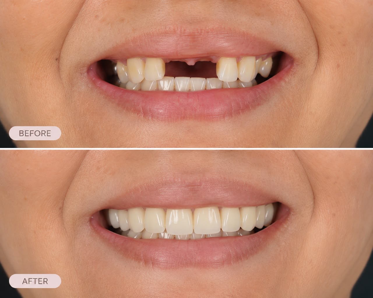 Before and after smile transformation at FTS Chin Dental — missing front tooth restored with crowns, bridges or dentures in Kota Kinabalu